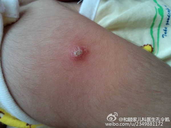 科技之光,最新卡介苗引领健康新纪元