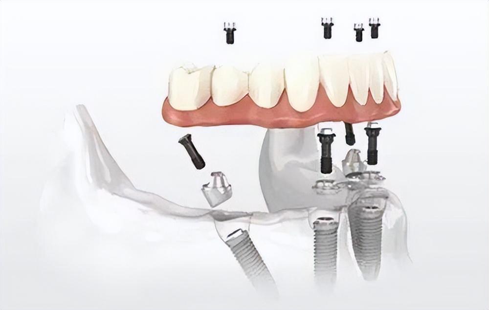 镶牙费用详解,医院镶牙价格指南