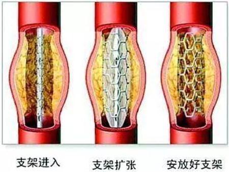 支架再狭窄研究最新进展概述